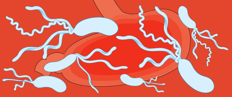 Helicobacter pylori a léčba této zákeřné bakterie